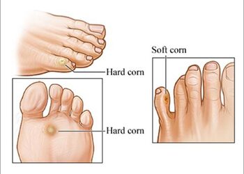 Corntreatmentinmadurai 1 
