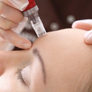 Microneedeling