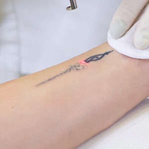 Tattooremoval1