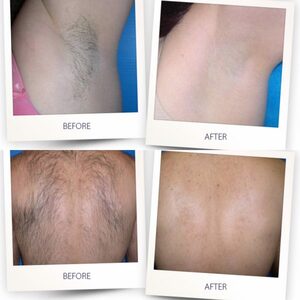 Hair removal