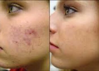 Antiacne