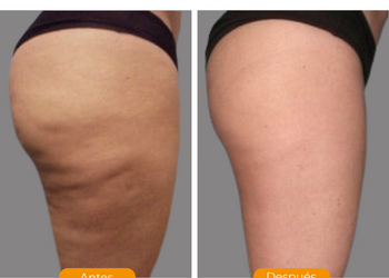 Antes y despues  alidya