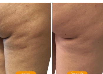 Antes y despues  alidya 2