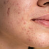 Acnescars