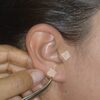 Auriculoterapia1