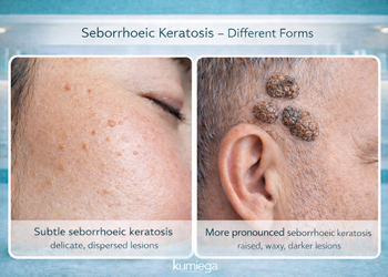 Different seborreic keratosis chatgpt image dec 30  2025  03 10 13 pm