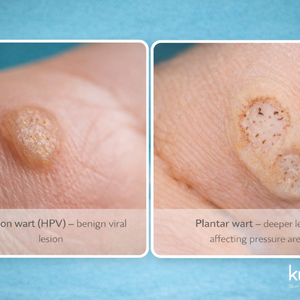 Hpv warts chatgpt image dec 30  2025  03 33 45 pm