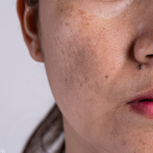 Facial despigmentante