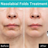 Nasolabialfoldstreatment 1