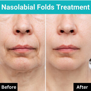 Nasolabialfoldstreatment 1